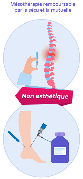 Mésothérapie remboursable par la sécu et la mutuelle